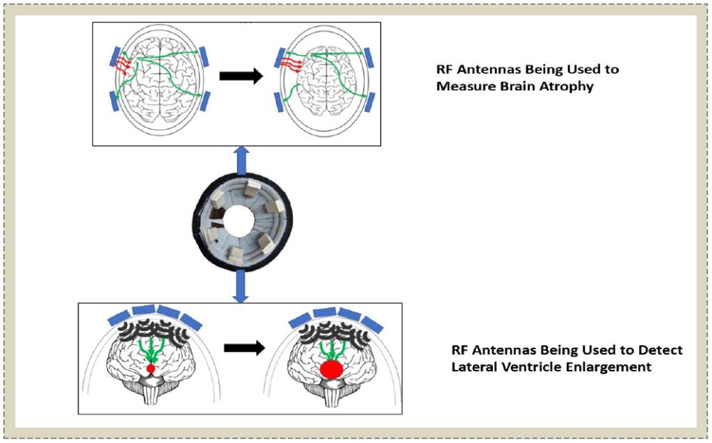 Non-Invasive Wearable RF Device towards Monitoring Brain Atrophy and Lateral Ventricle Enlargement
