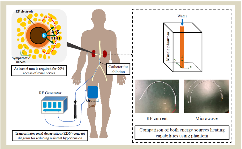 Comparison of Radio Frequency Current and Microwave Energy for Transcatheter Renal Denervation
