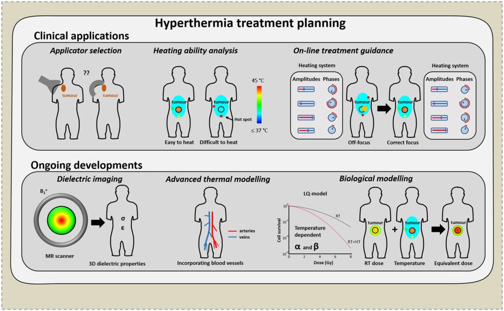 Hyperthermia Treatment Planning: Clinical Application and Ongoing Developments