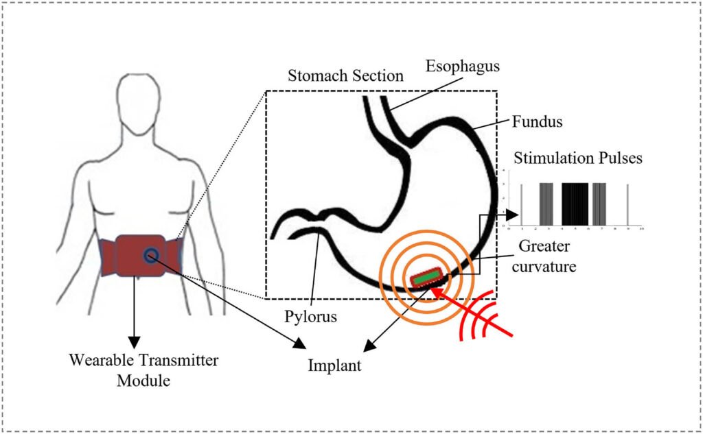 Implantable Radio Frequency Powered Gastric Electrical Stimulator