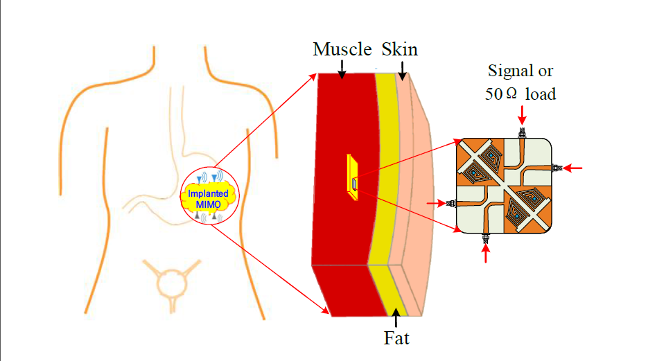 A Miniaturized Four-Element MIMO Antenna with EBG for Implantable Medical Devices