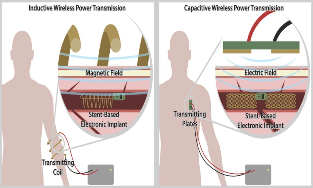 Near Field Wireless Power Transfer to Stent-Based Biomedical Implants